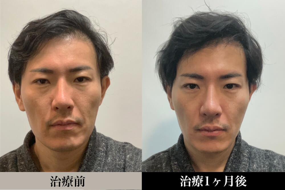 PRPビフォアフ PRPビフォアフ