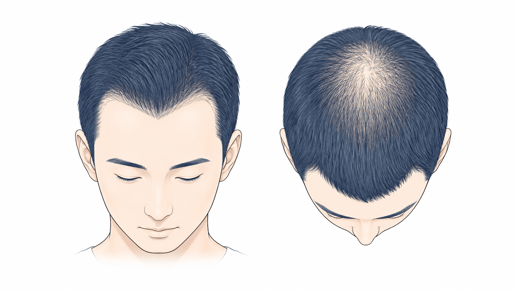 生え際と頭頂部を中心に徐々に薄毛が進行するAGAのイメージ