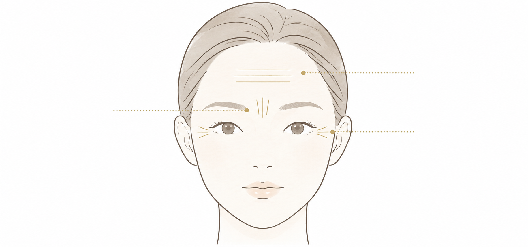 額・眉間・目尻などの表情じわを示したボトックス治療のイラスト