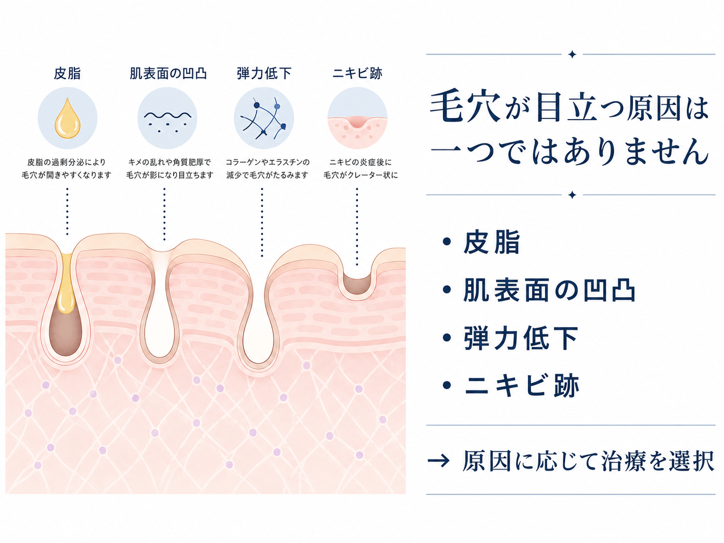 皮脂、肌表面の凹凸、弾力低下、ニキビ跡など毛穴が目立つ原因を示したイラスト