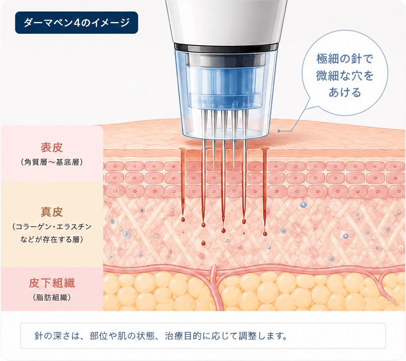 ダーマペン4の極細針が皮膚に微細な穿刺を行う仕組みを示した断面図