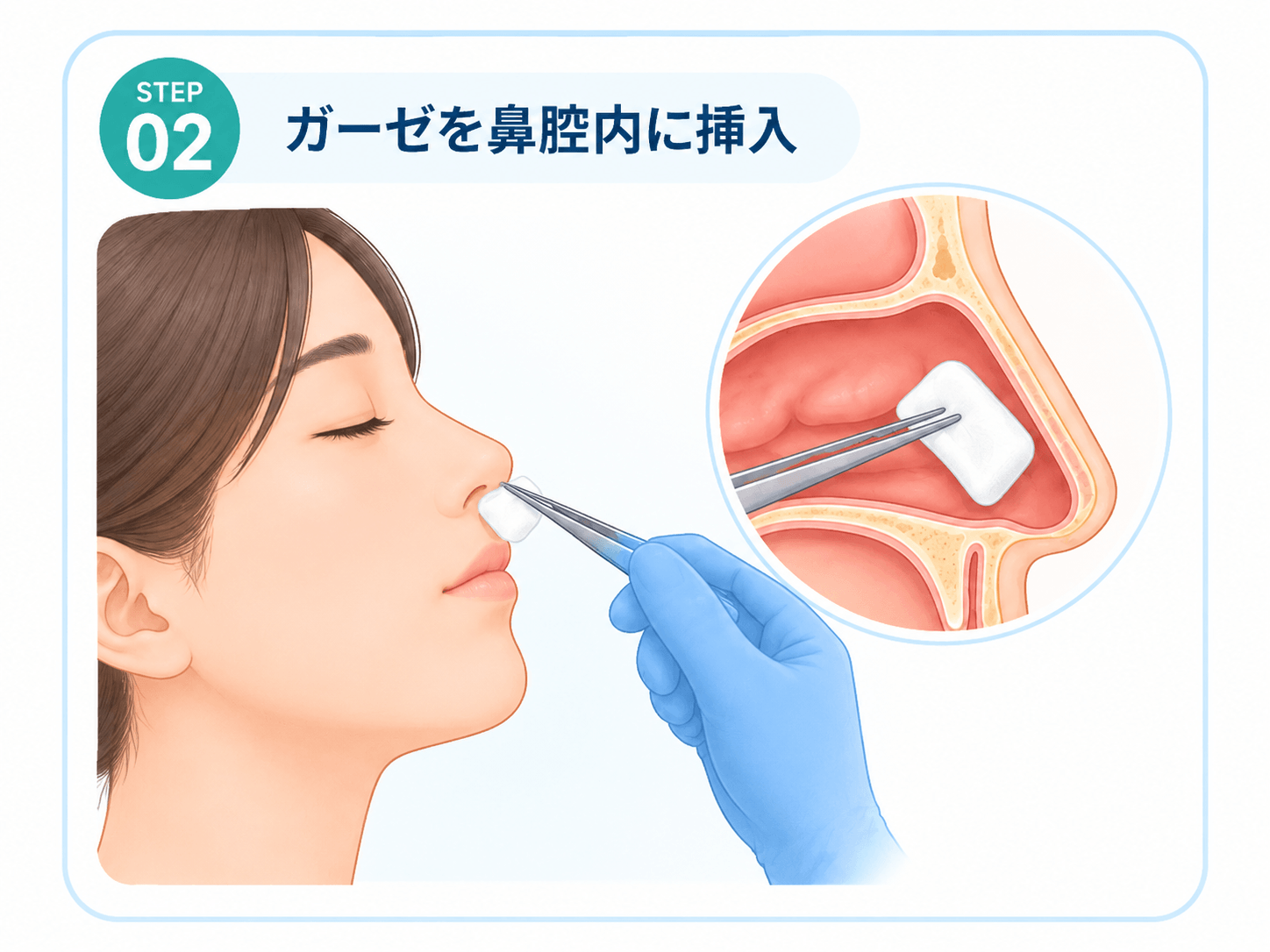 薬液を含ませたガーゼを鼻腔内へ挿入する工程