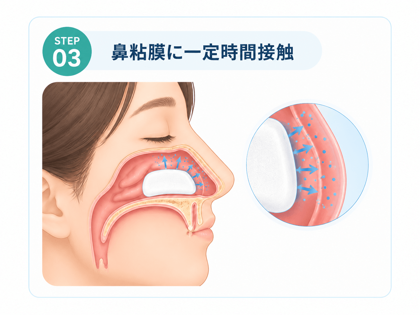ガーゼを鼻粘膜に一定時間接触させる花粉症ボトックスの工程