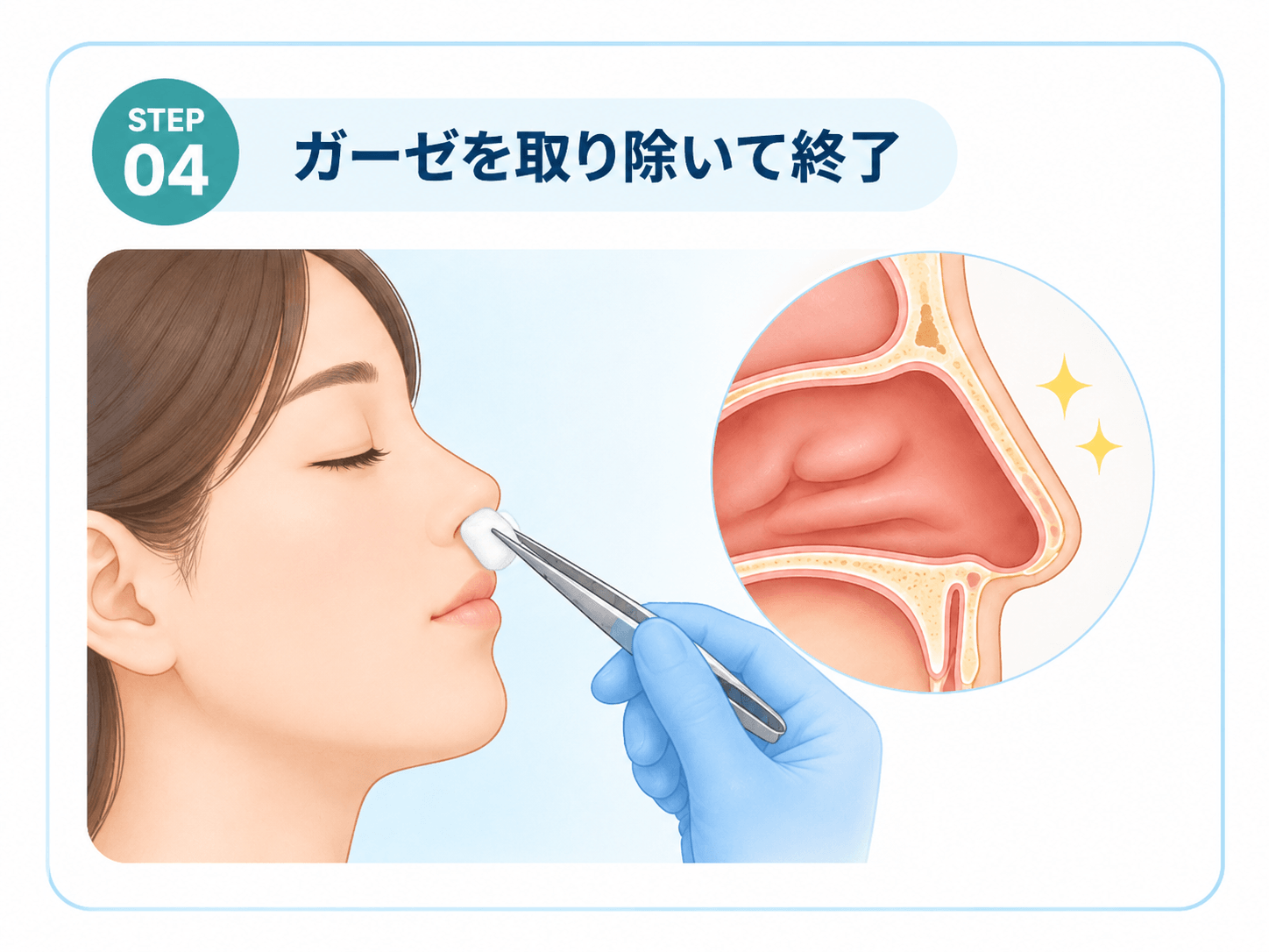 鼻腔内からガーゼを取り除いて花粉症ボトックスを終了する工程