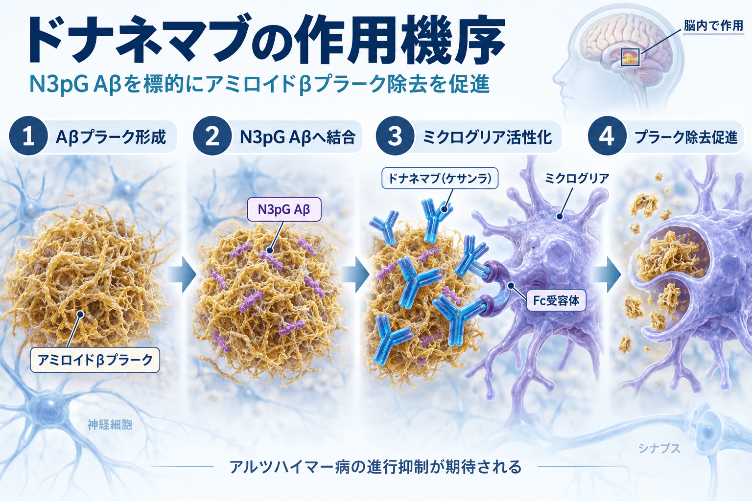 ドナネマブ（ケサンラ）の作用機序。N3pGアミロイドβに結合し、ミクログリアによるアミロイドβプラーク除去を促進する仕組み